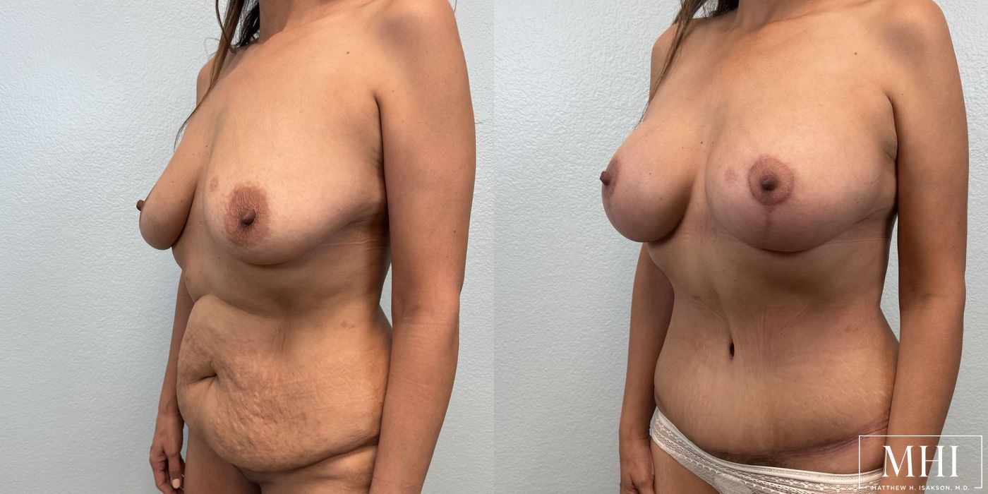 Breast Augmentation with Lift - Thumbnail 2