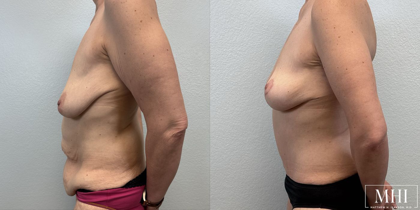 Breast Lift - Thumbnail 3