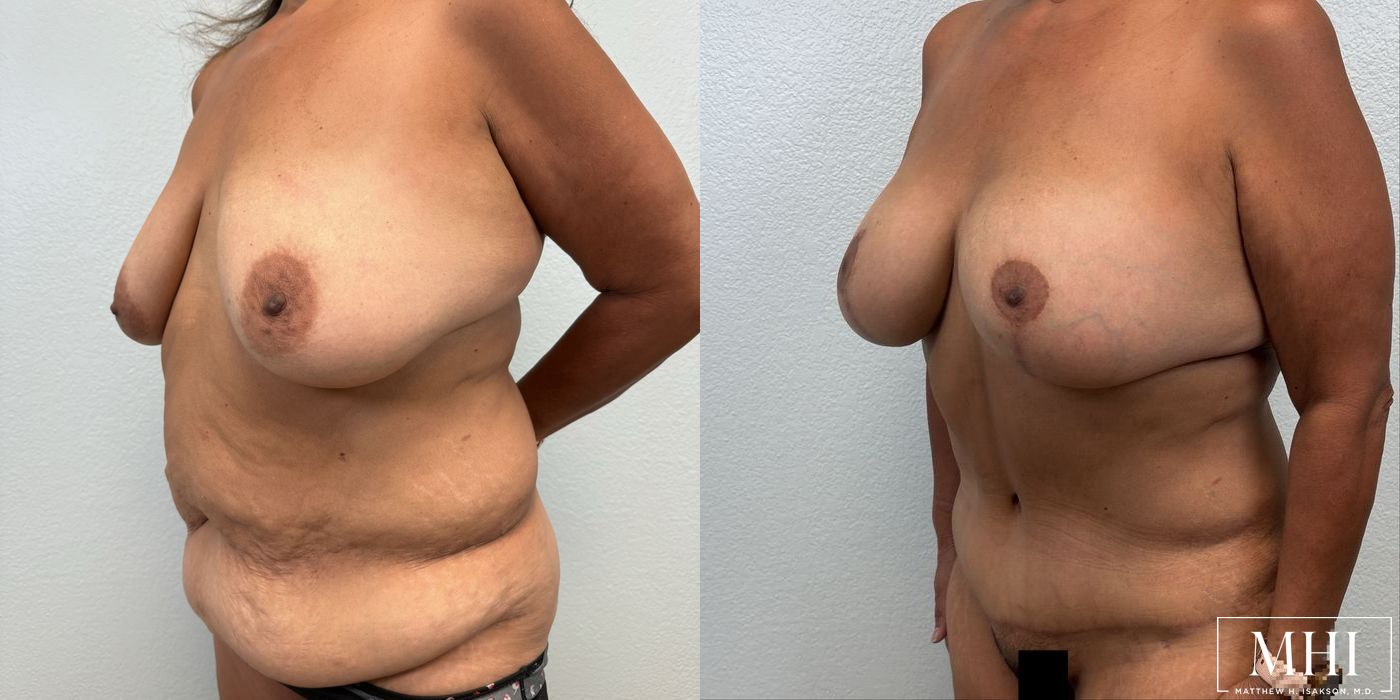 Mommy Makeover - Thumbnail 2