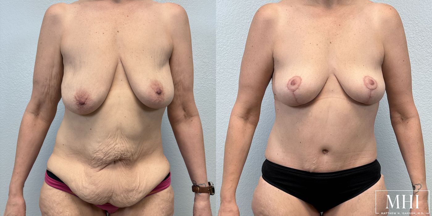 Breast Lift - Case 12146