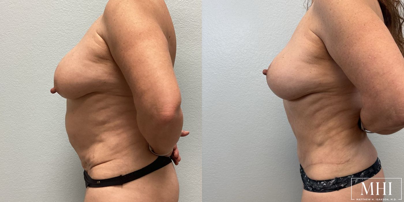 Mommy Makeover - Thumbnail 2