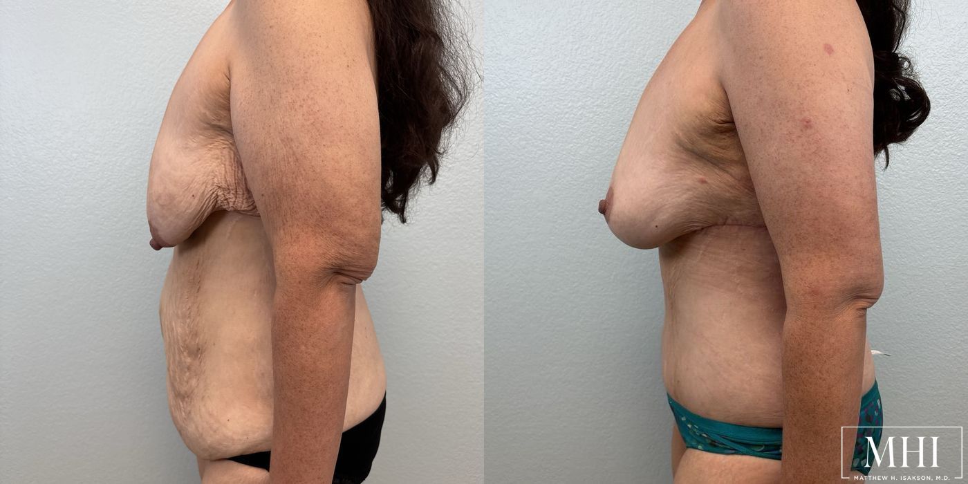 Breast Lift - Thumbnail 3