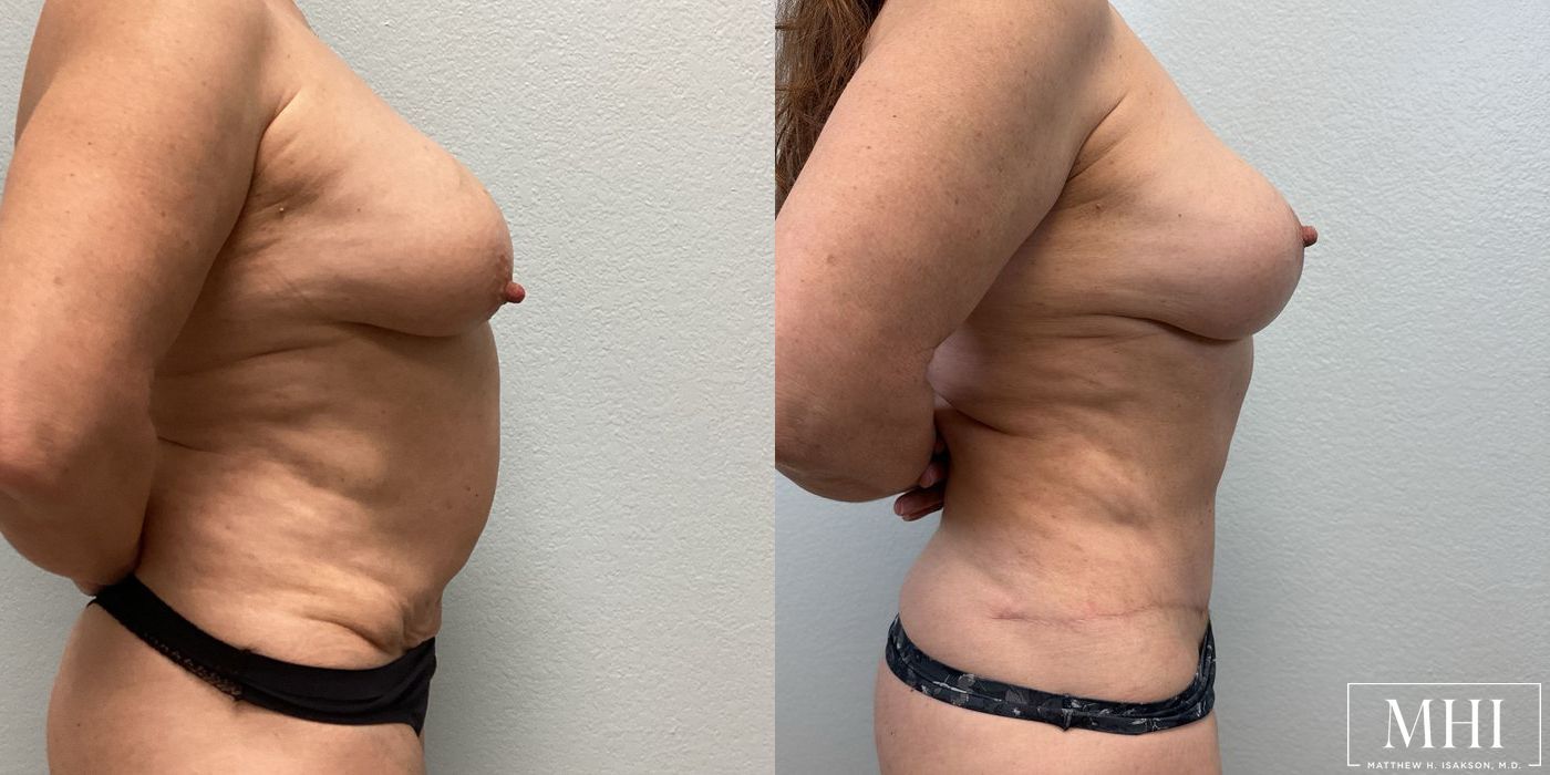 Mommy Makeover - Thumbnail 5