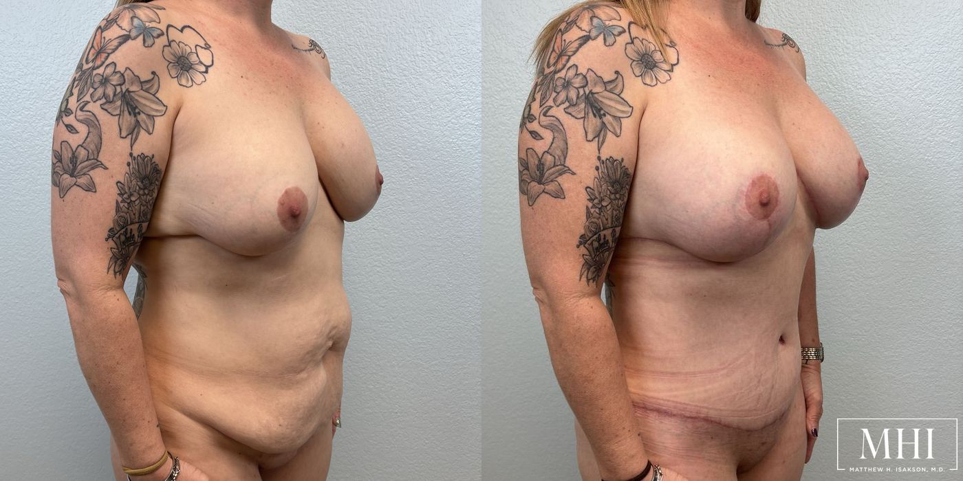 Breast Lift - Thumbnail 4