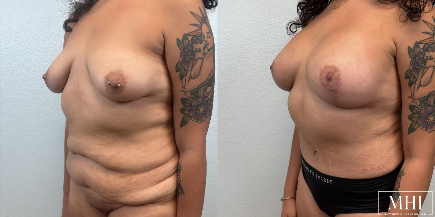 Breast Augmentation with Lift - Thumbnail 4