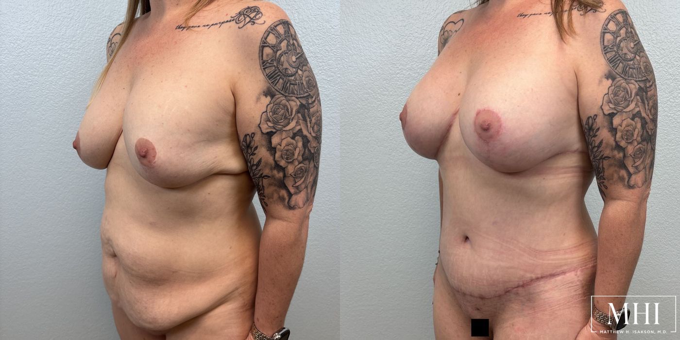 Breast Lift - Thumbnail 2