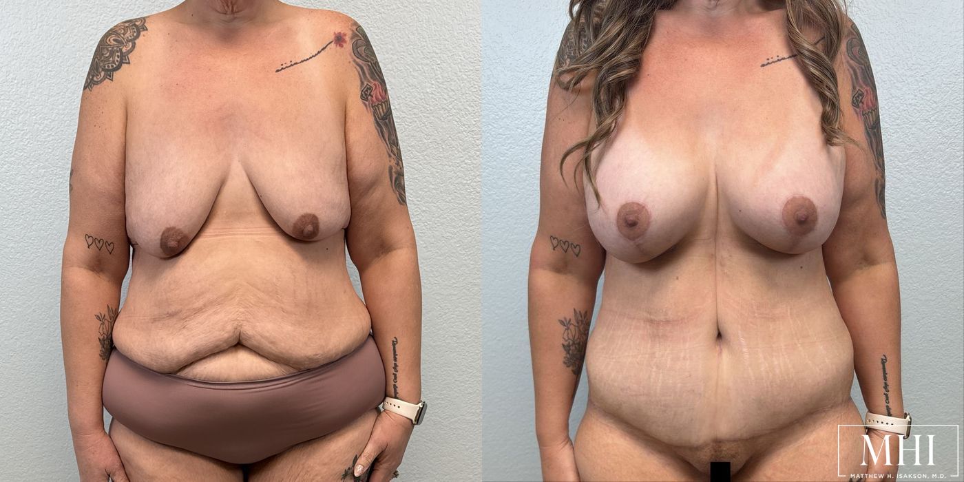 Breast Augmentation with Lift - Thumbnail 3