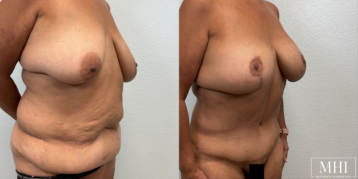 Mommy Makeover - Thumbnail 4