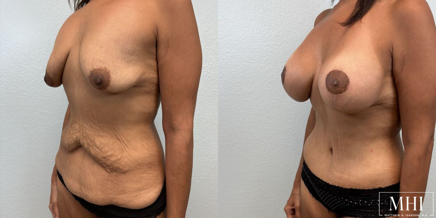 Breast Augmentation with Lift - Thumbnail 2