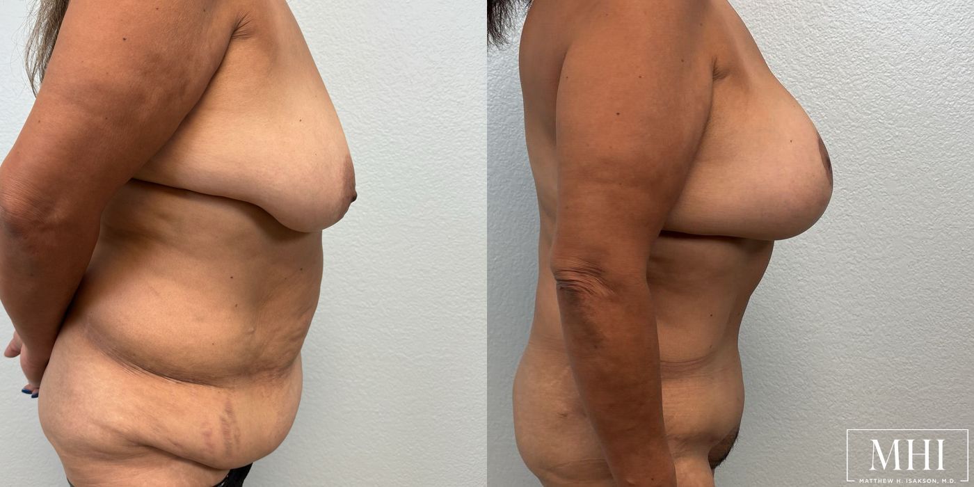 Mommy Makeover - Thumbnail 5