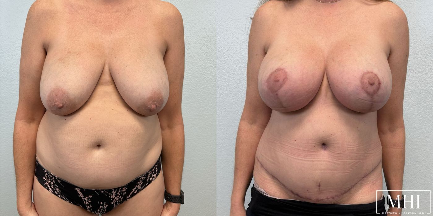 Breast Augmentation with Lift - Thumbnail 3