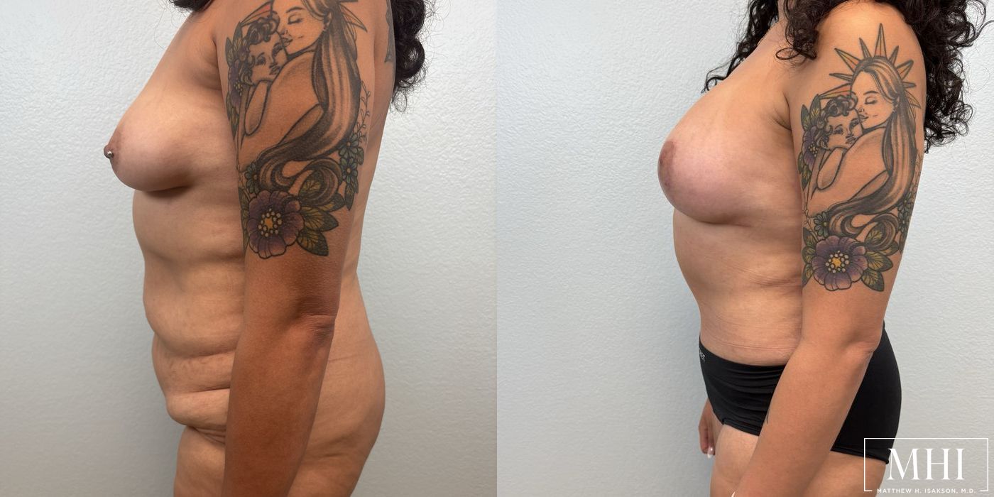 Breast Augmentation with Lift - Thumbnail 5