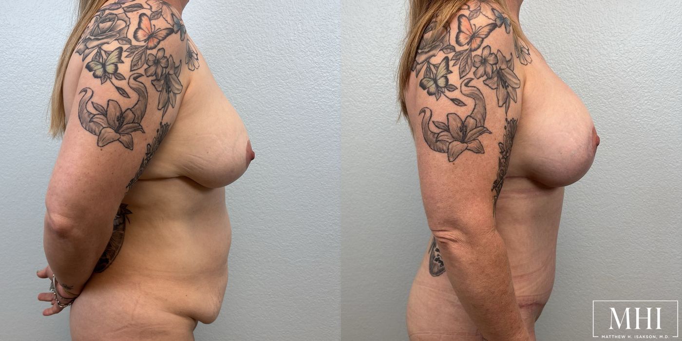 Breast Implant Capsulectomy, Total - Thumbnail 5