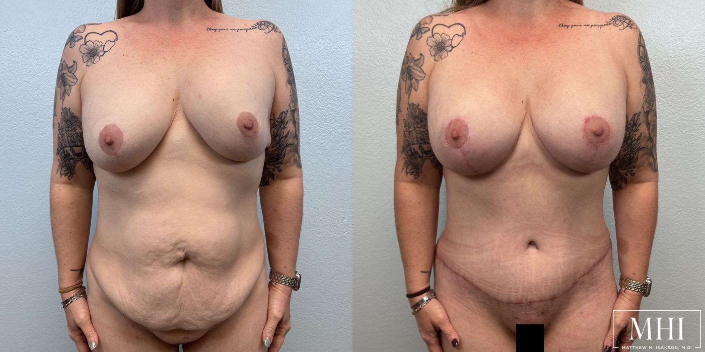Breast Implant Capsulectomy, Total - Case 12137