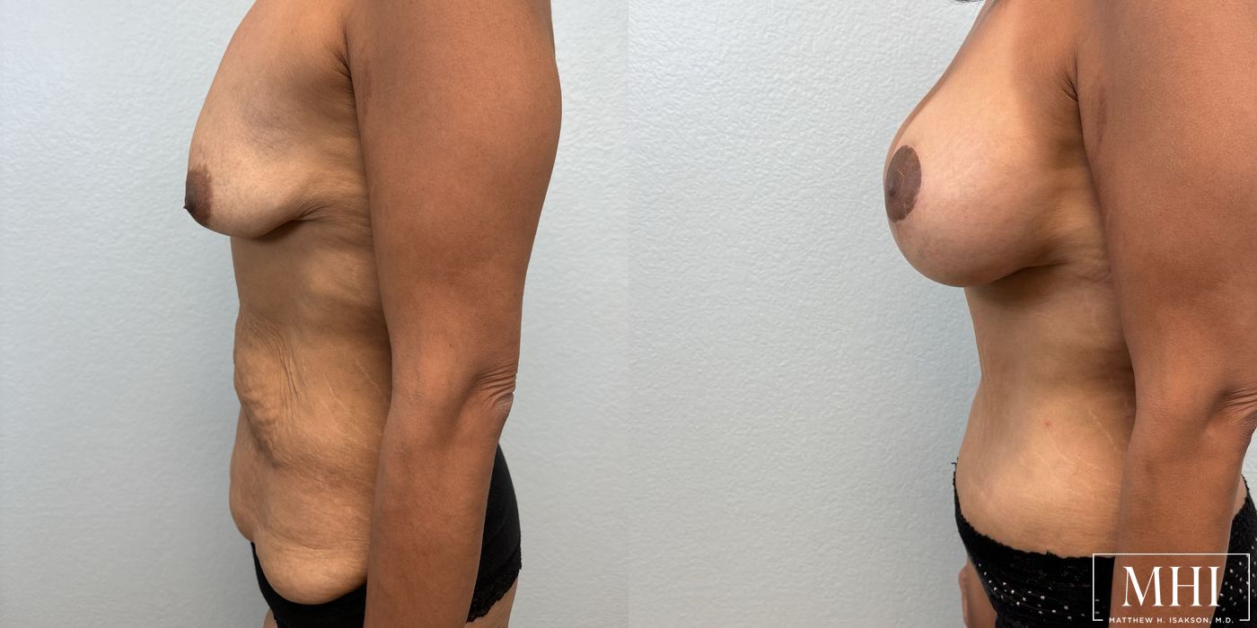 Breast Augmentation with Lift - Thumbnail 3