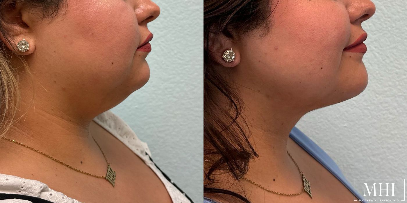 Submental liposuction - Case 12498