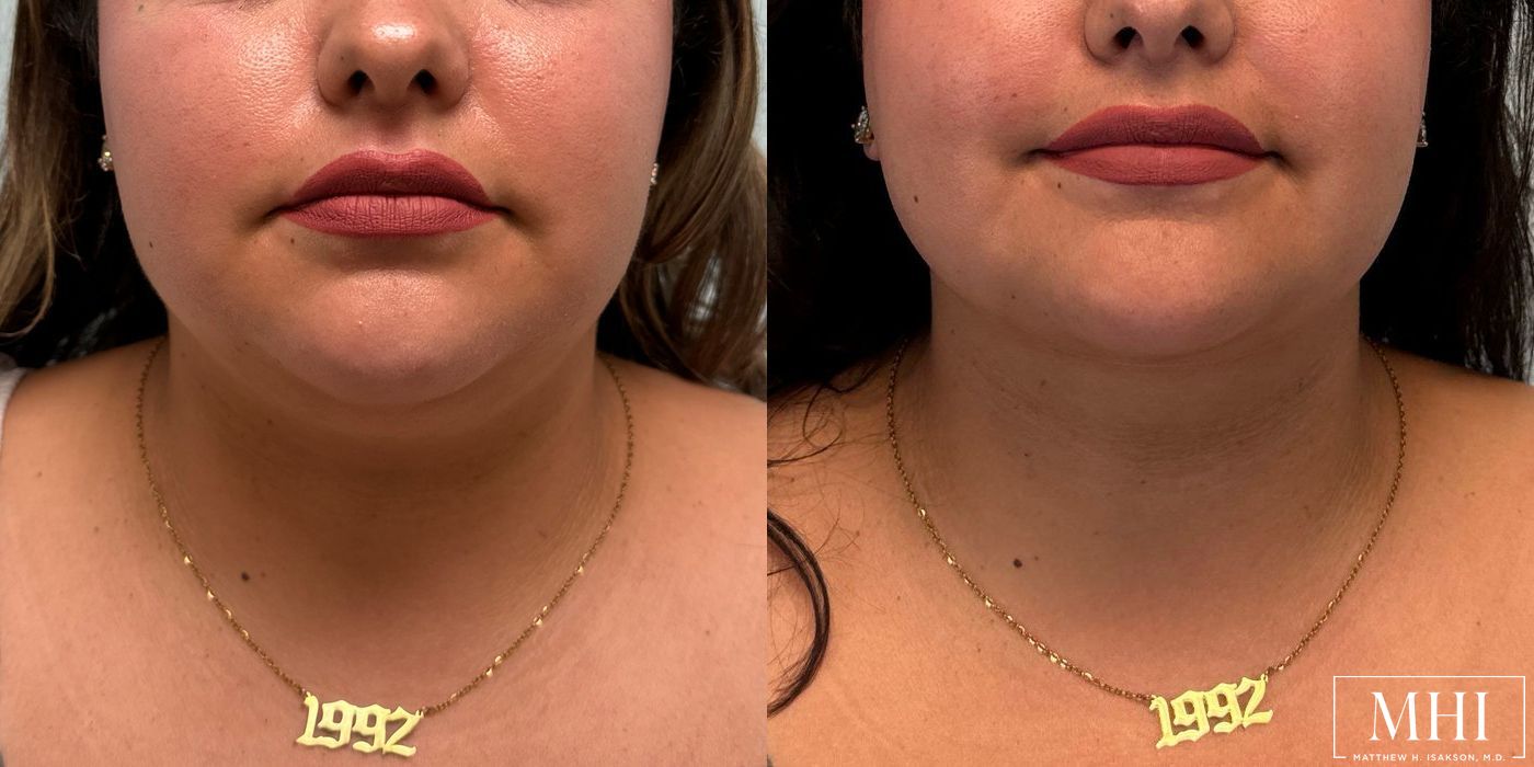 Submental liposuction - Thumbnail 5