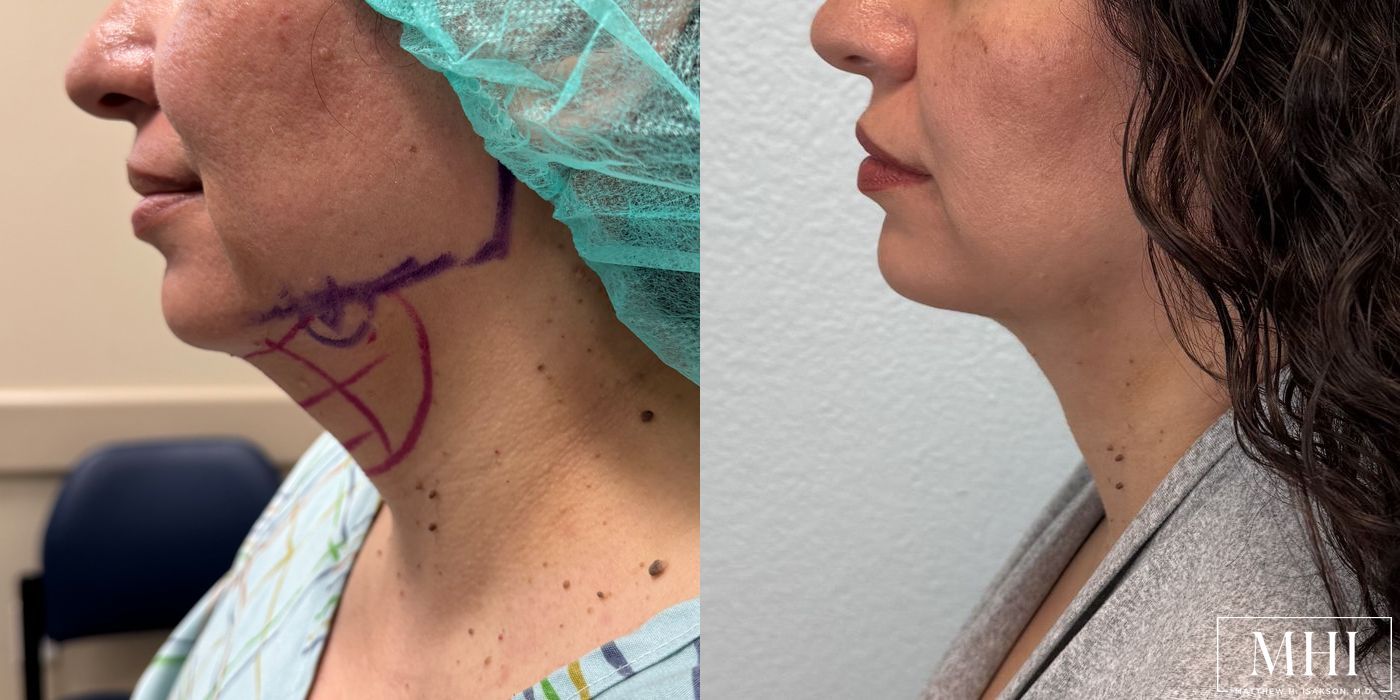 Submental liposuction - Case 12500