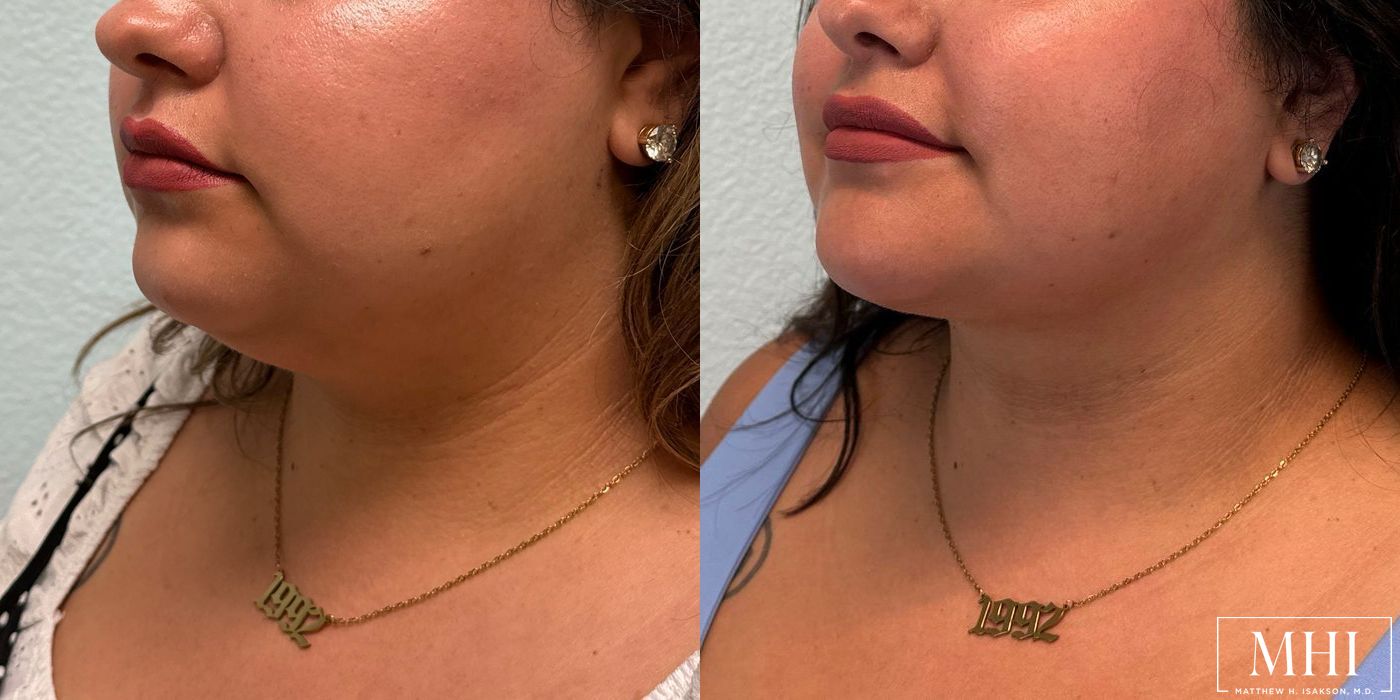 Submental liposuction - Thumbnail 4