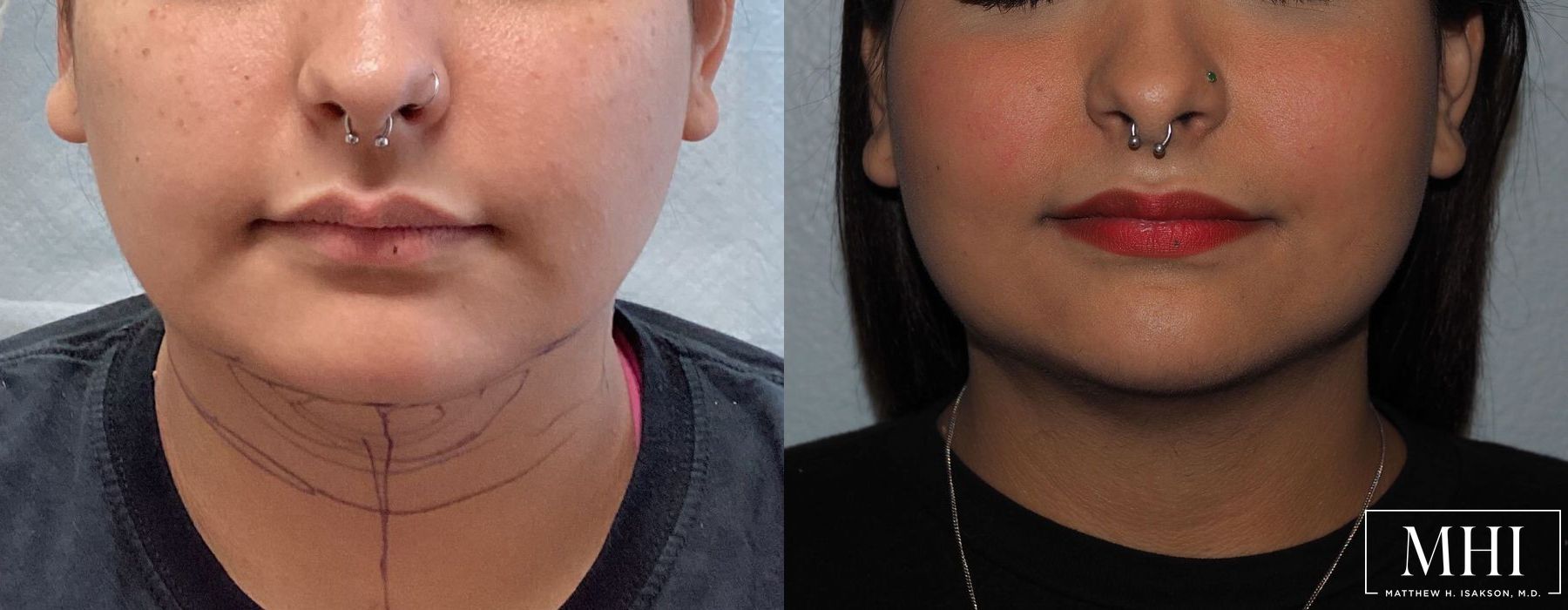 Submental liposuction - Thumbnail 2