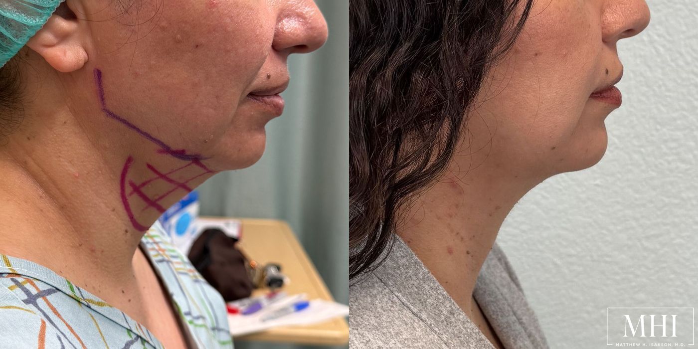 Submental liposuction - Thumbnail 2