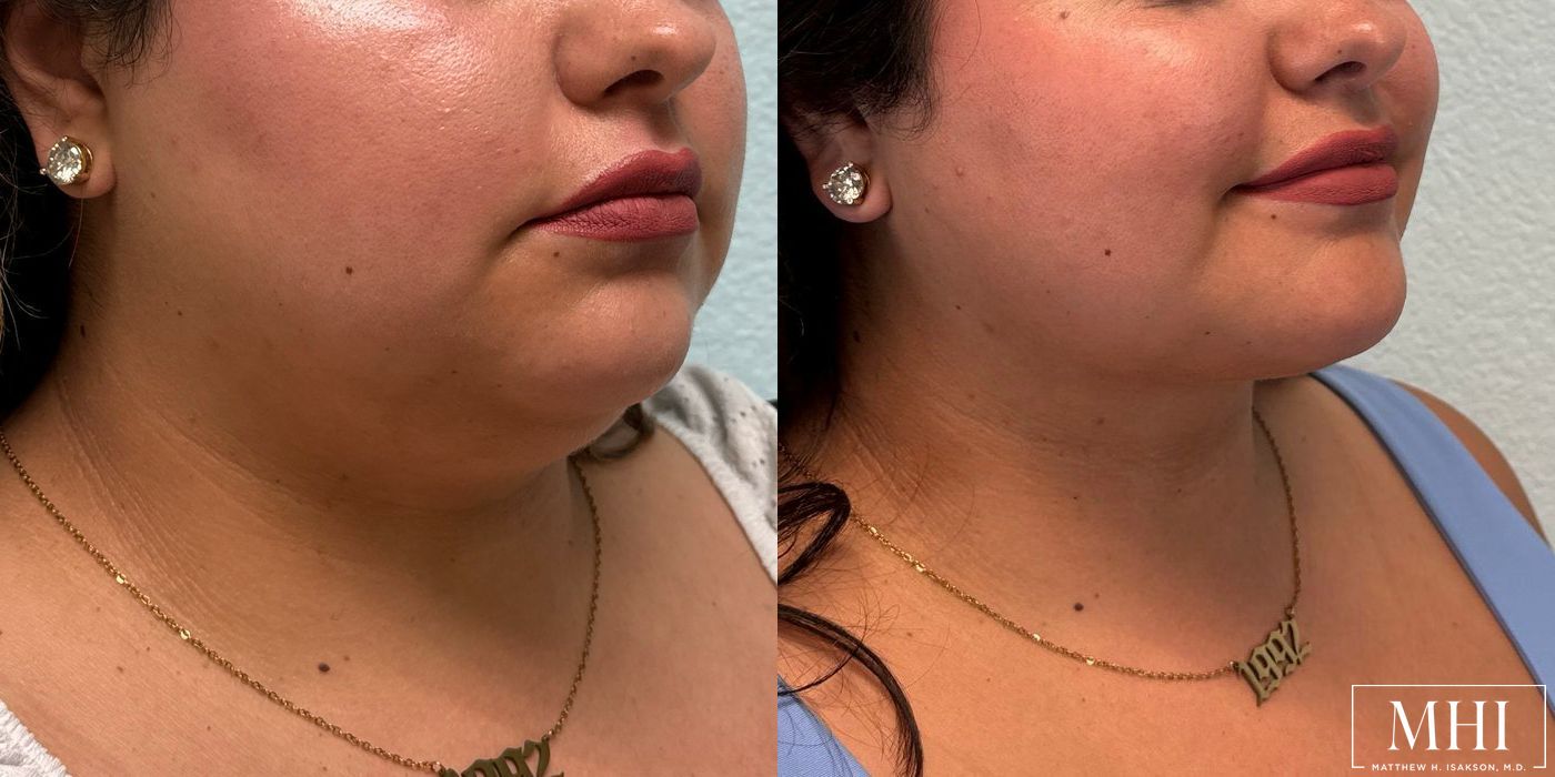 Submental liposuction - Thumbnail 2