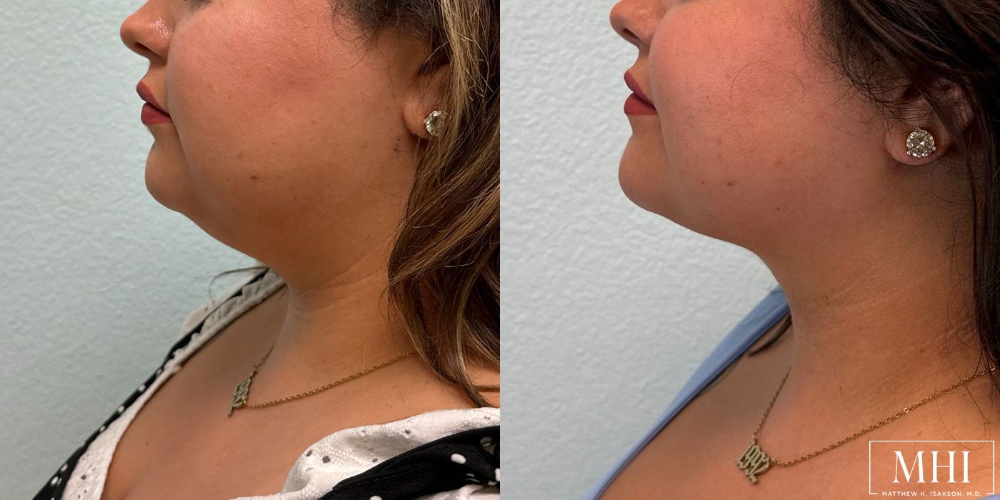 Submental liposuction - Thumbnail 3