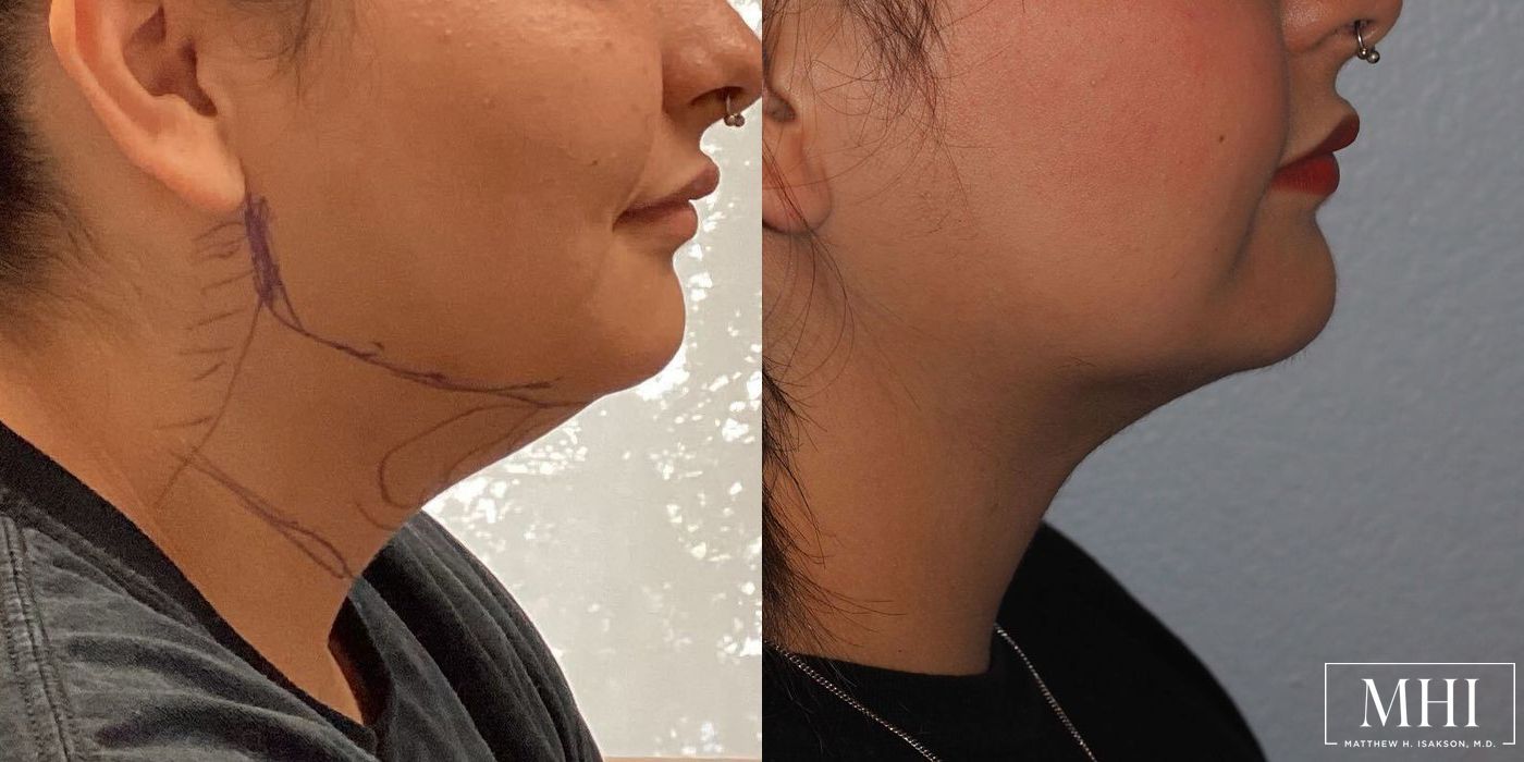 Submental liposuction - Case 12499