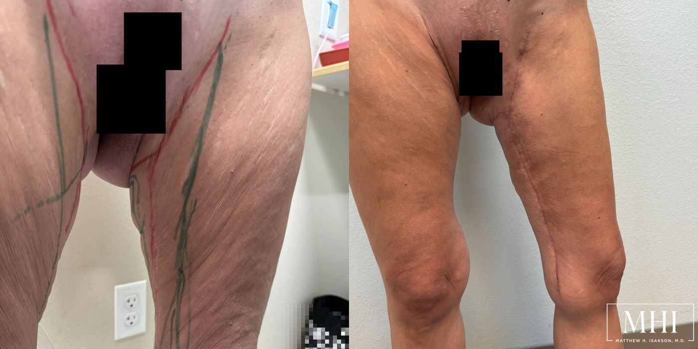 Thigh Lift - Case 12380