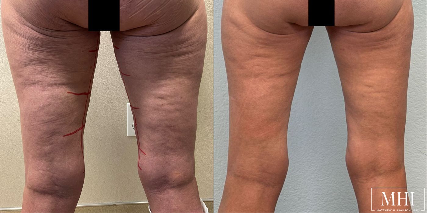 Thigh Lift - Thumbnail 6