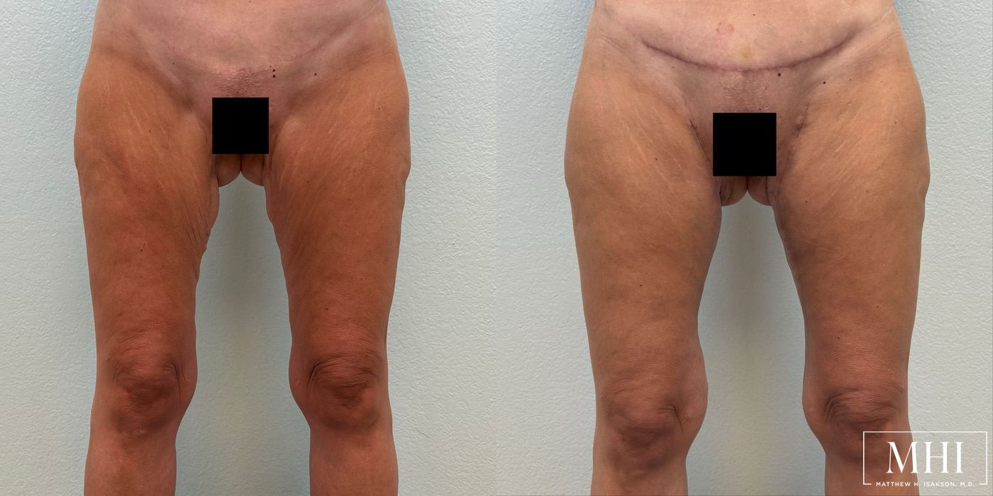 Thigh Lift - Thumbnail 3