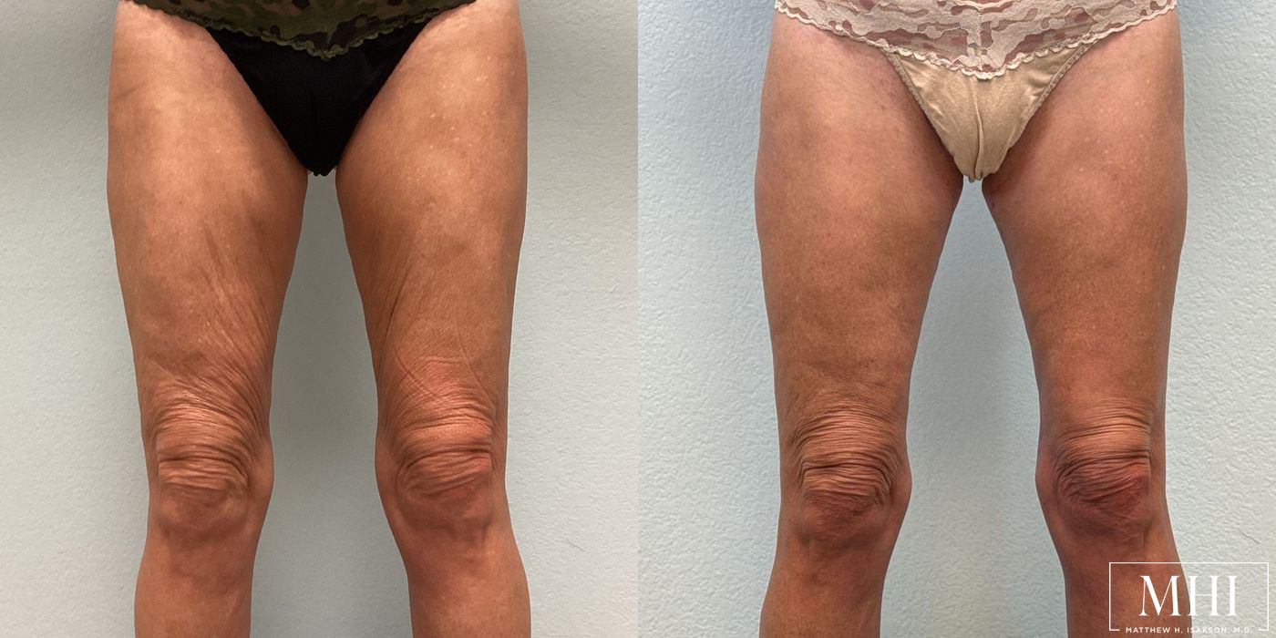 Thigh Lift - Thumbnail 3