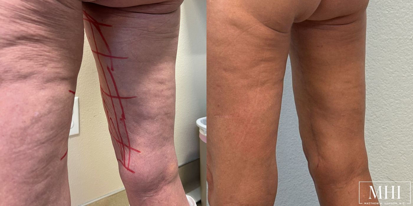 Thigh Lift - Thumbnail 5