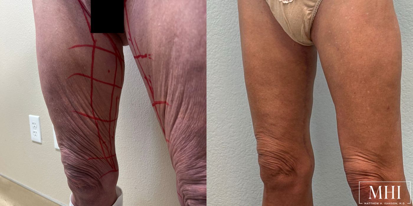 Thigh Lift - Thumbnail 4