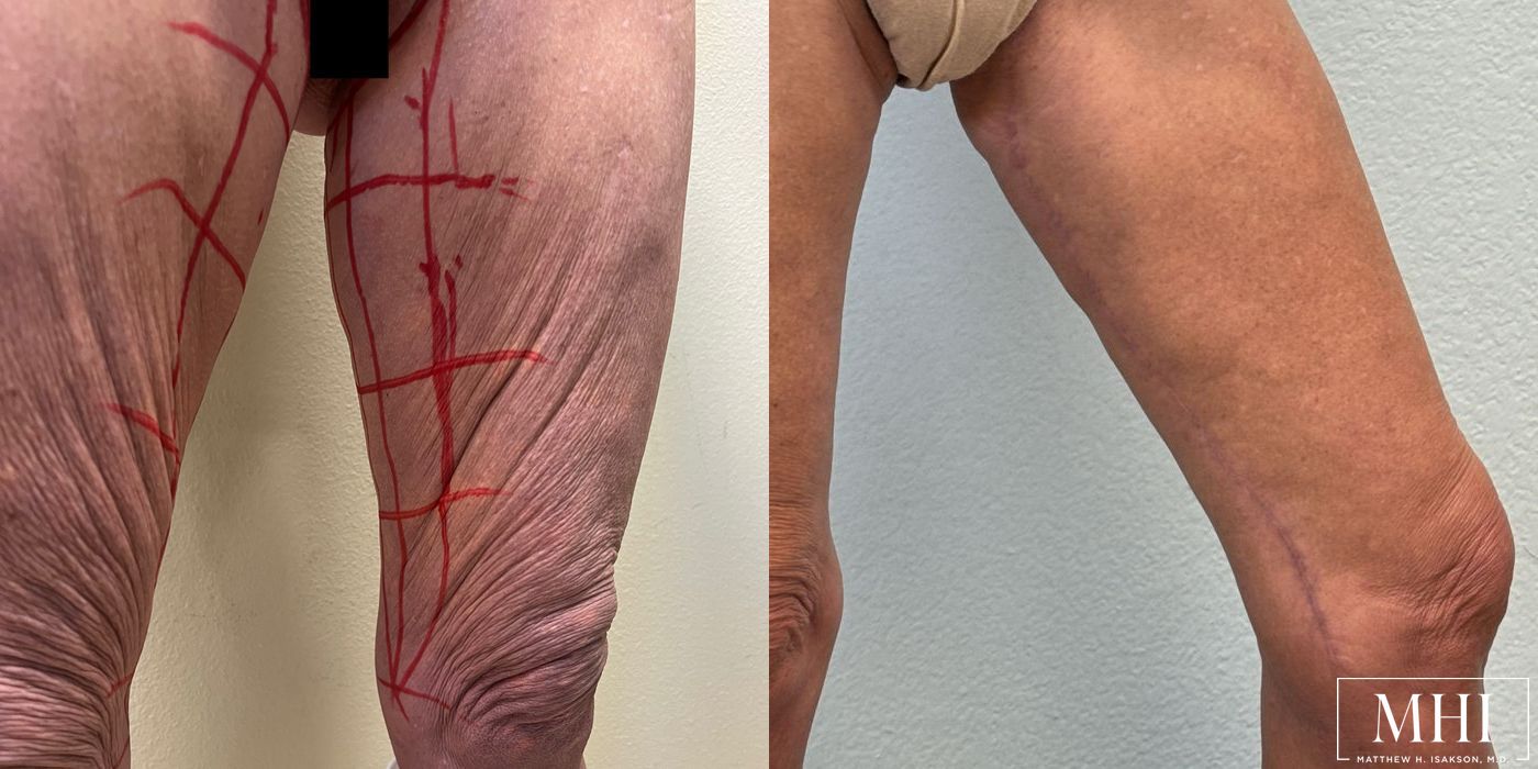 Thigh Lift - Case 12379