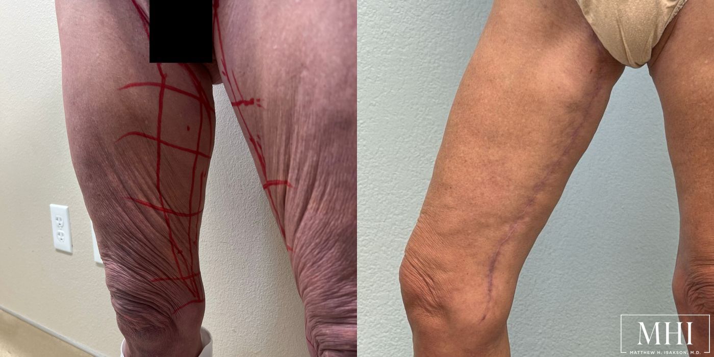 Thigh Lift - Thumbnail 2