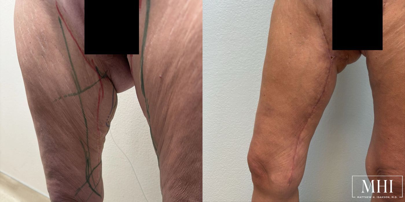 Thigh Lift - Thumbnail 2