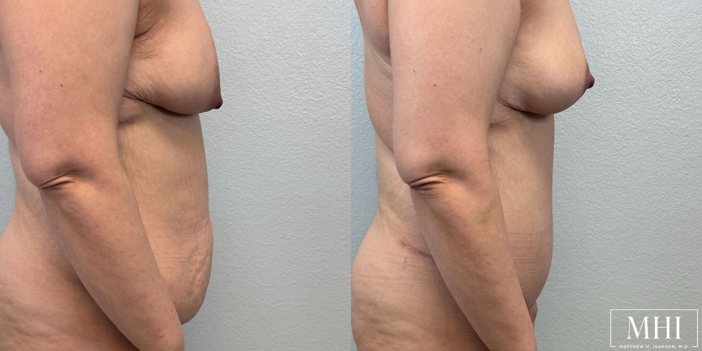 Tummy Tuck - Thumbnail 2