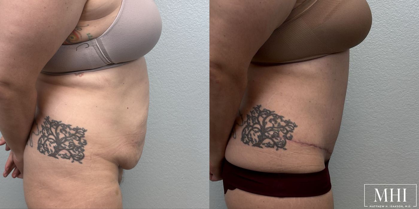 Tummy Tuck - Case 12382