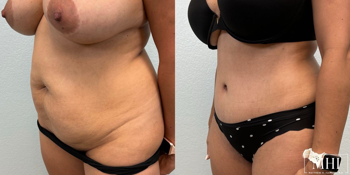 Tummy Tuck - Thumbnail 2