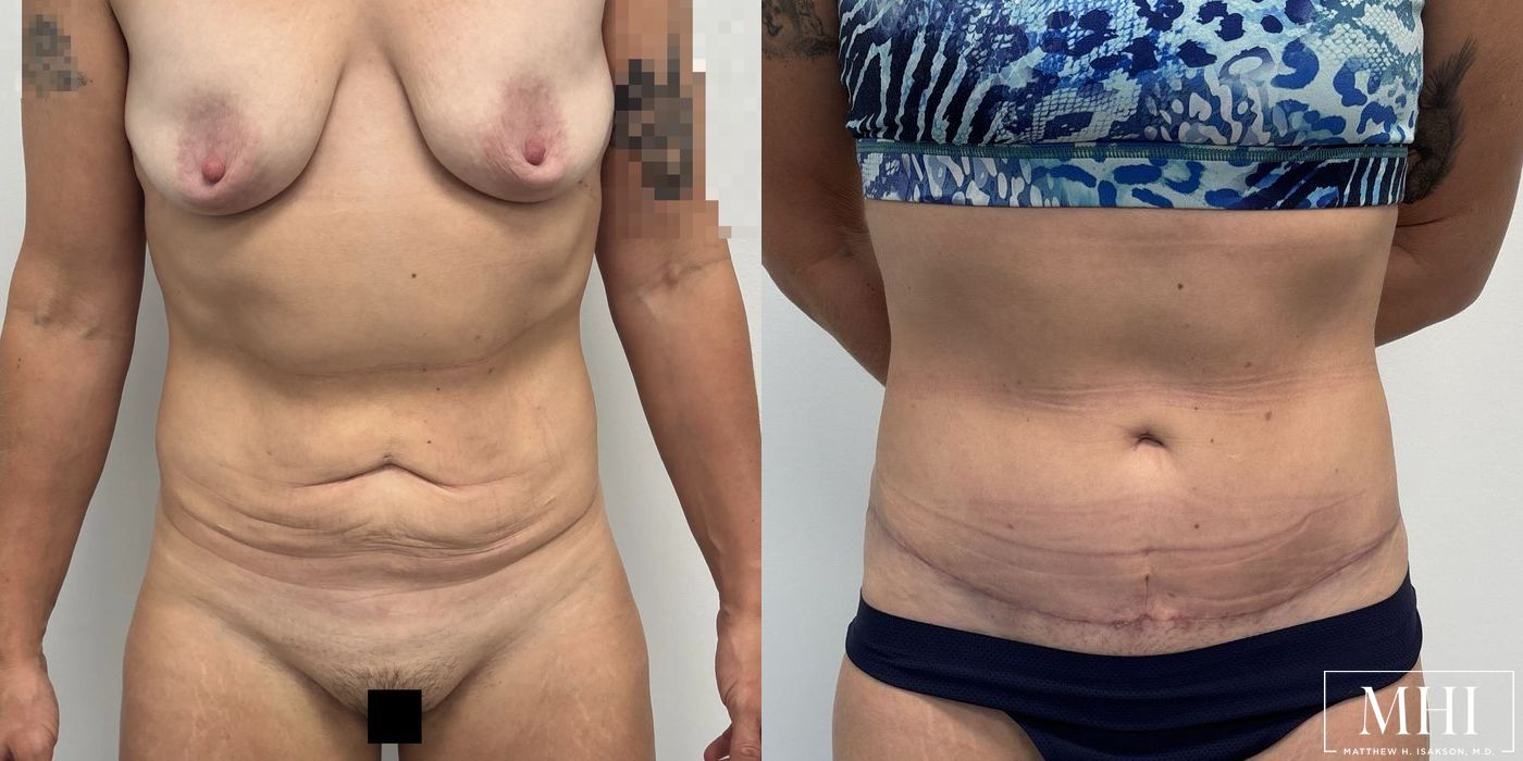 Tummy Tuck - Case 12385