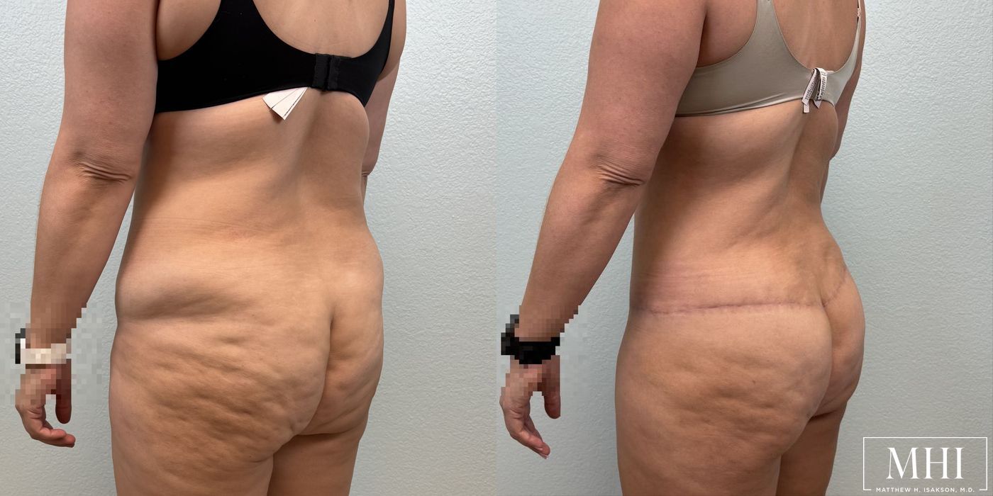 Lower Body Lift Belt Lipectomy - Thumbnail 5