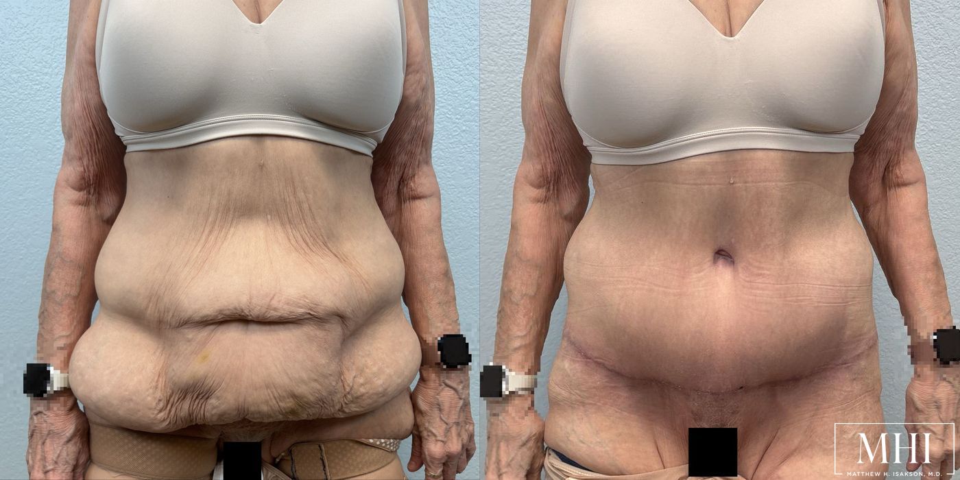 Tummy Tuck - Thumbnail 2