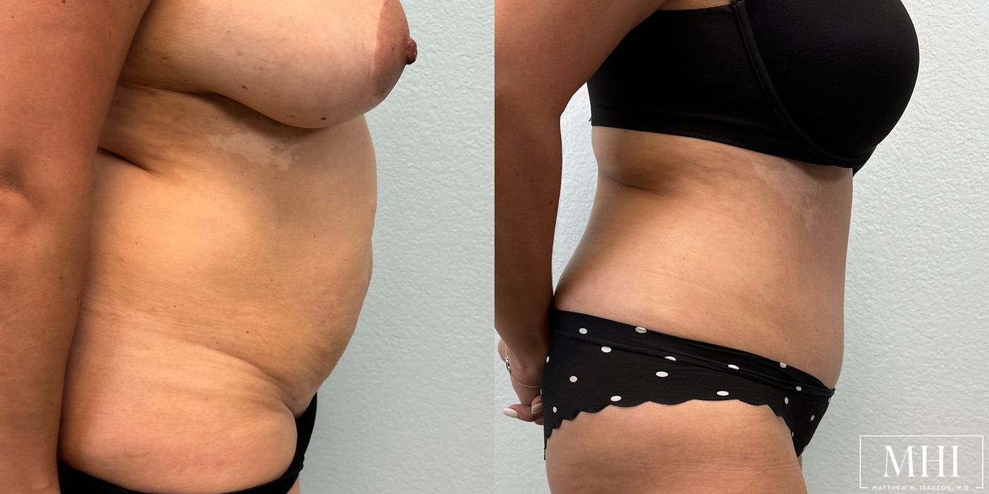 Tummy Tuck - Thumbnail 5