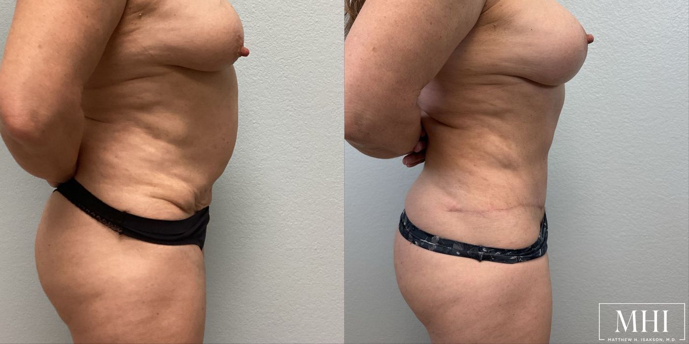 Tummy Tuck - Thumbnail 2