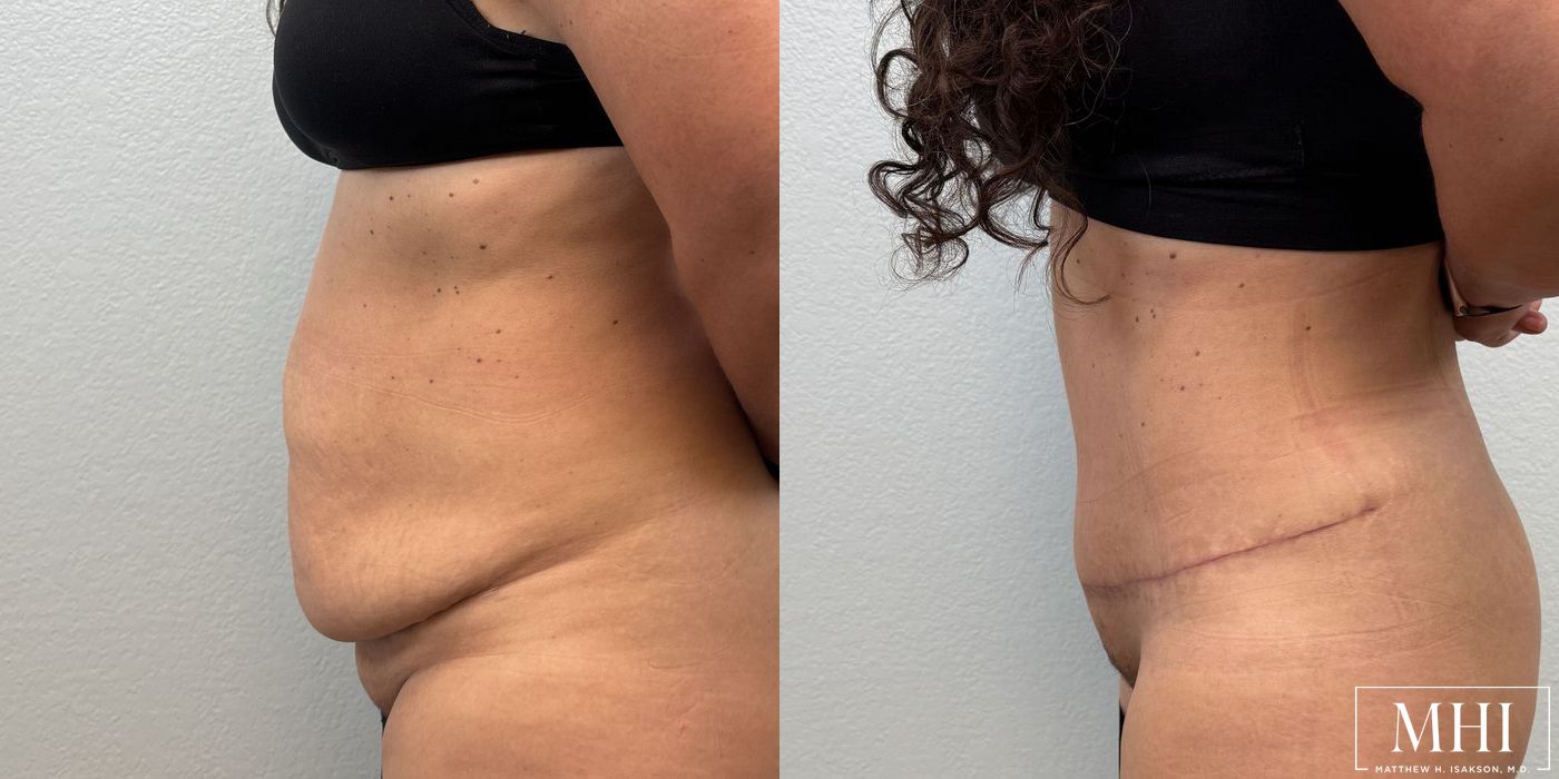 Tummy Tuck - Thumbnail 3