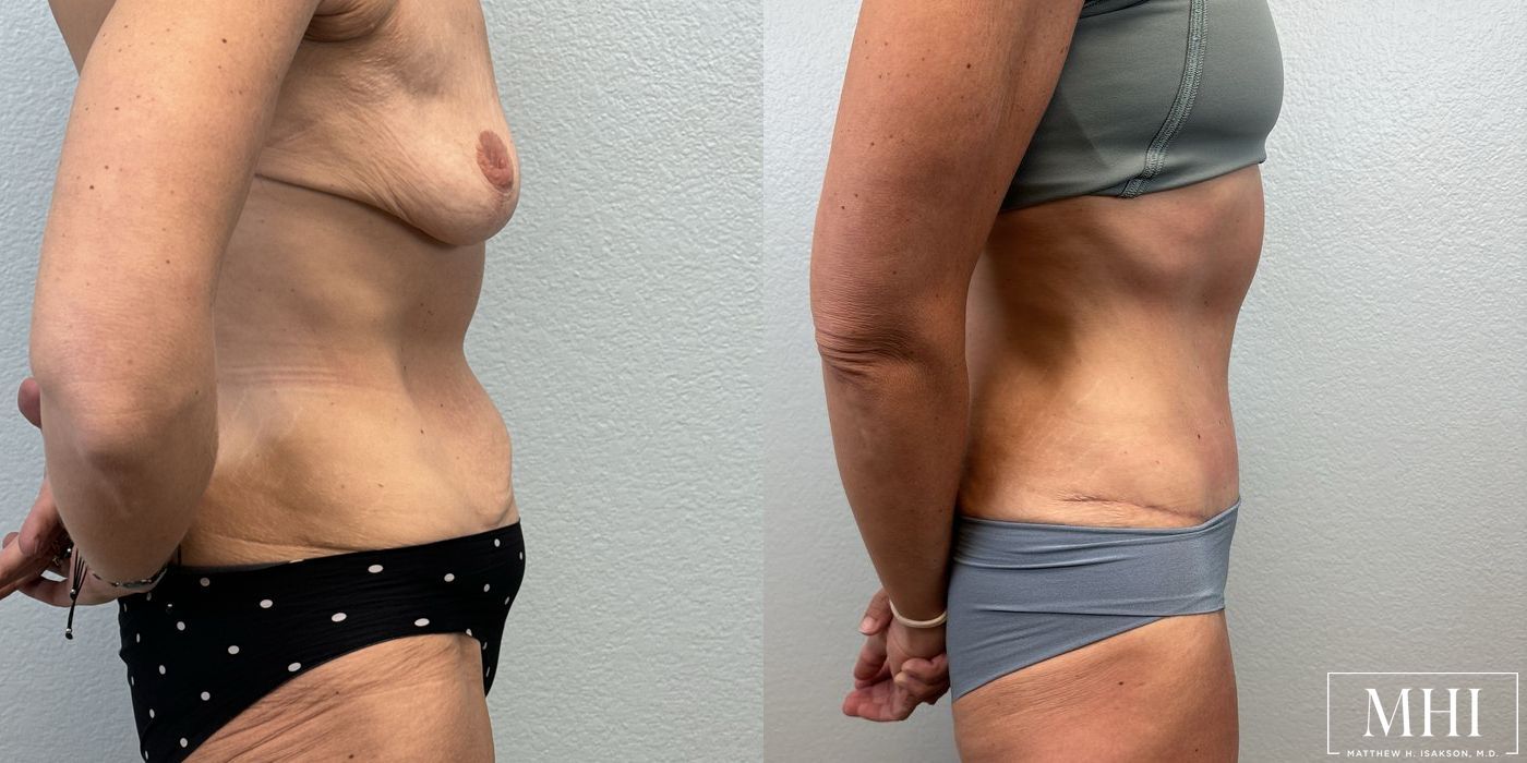 Tummy Tuck - Thumbnail 5