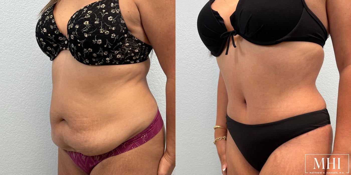 Tummy Tuck - Thumbnail 2