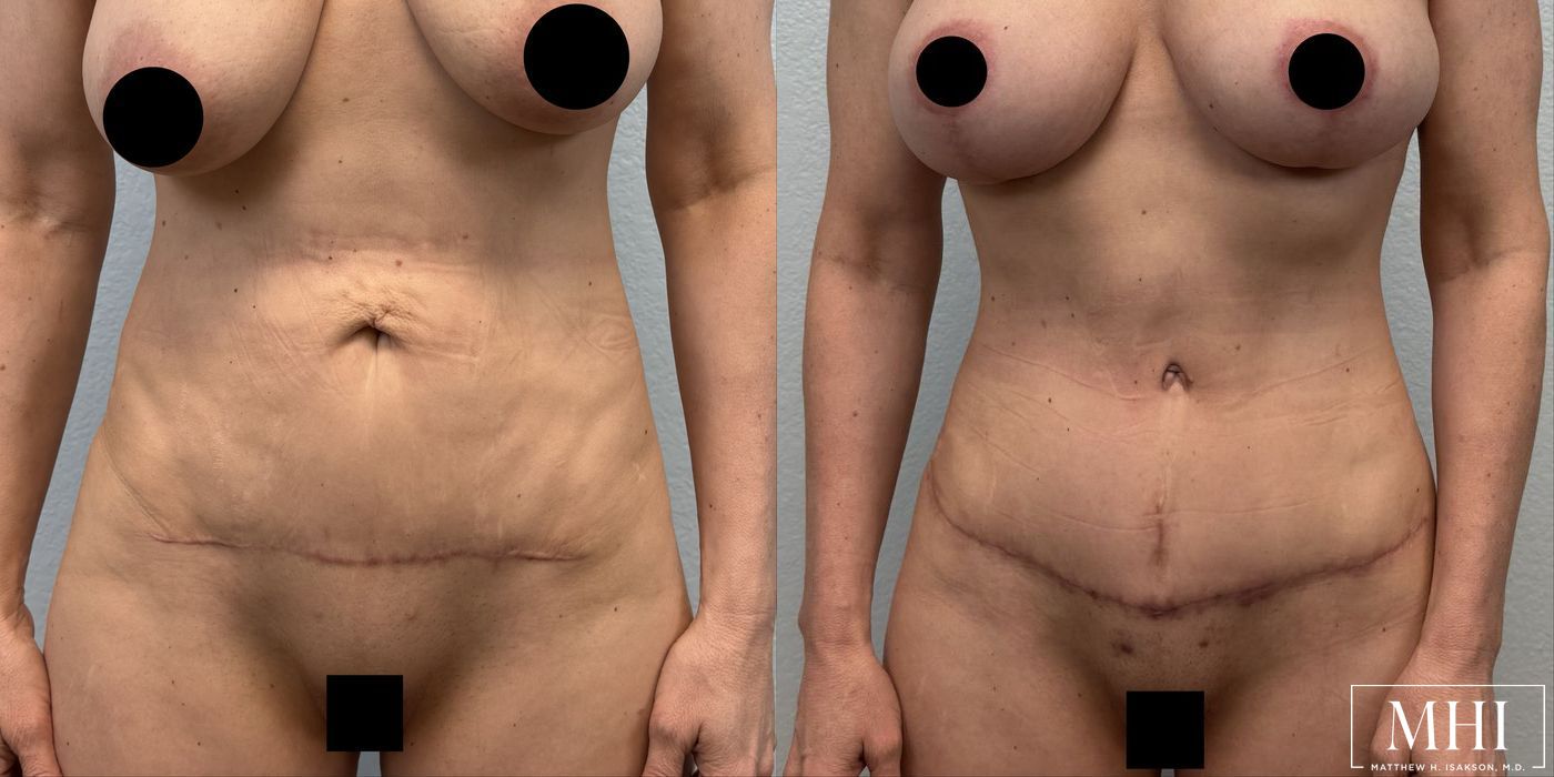 Tummy Tuck - Case 12411