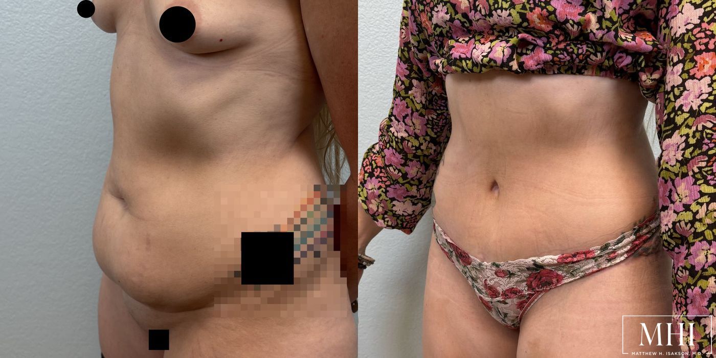 Tummy Tuck - Case 12100